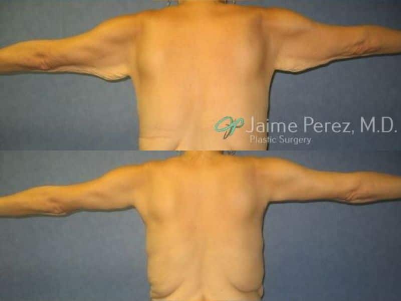 Arm Lift before and after
