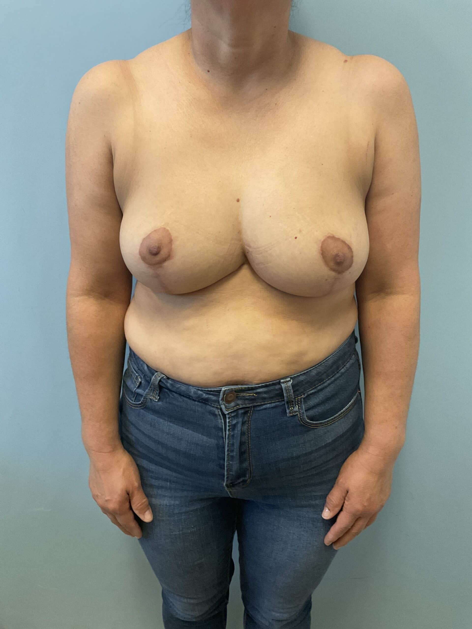 Breast-Reduction-Case-3264 | After Breast Reduction