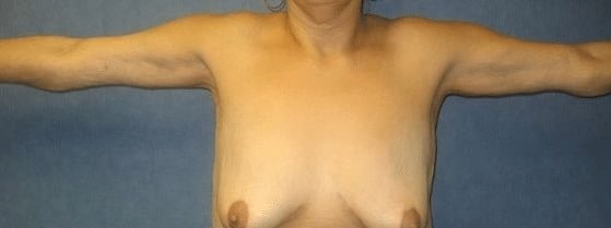 Arm-Lift-Case-4035 | Before Arm Lift