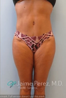 Lipo-Etching-Case-2492 | After Lipo Etching