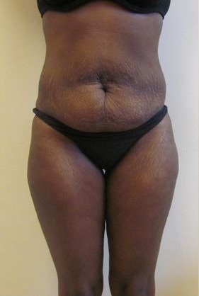 Tummy-Tuck-Case-8684 | Before Tummy Tuck