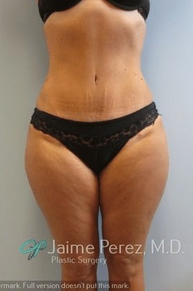 Tummy-Tuck-Case-4210 | After Tummy Tuck