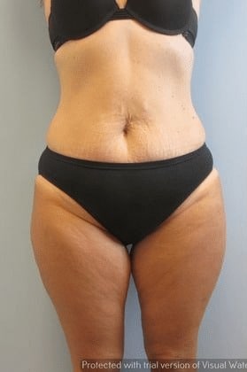 Tummy-Tuck-Case-4210 | Before Tummy Tuck