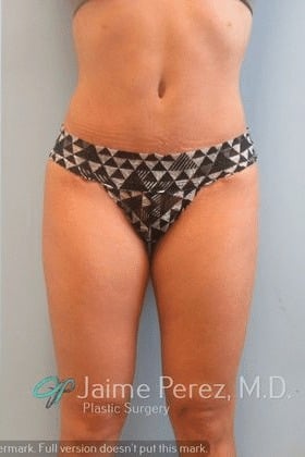 Tummy-Tuck-Case-2038 | After Tummy Tuck