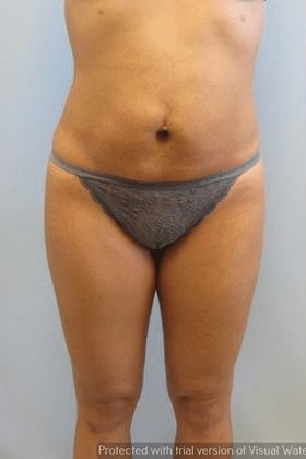 Tummy-Tuck-Case-2038 | Before Tummy Tuck