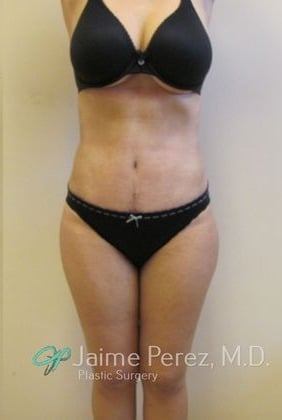 Tummy-Tuck-Case-3212 | After Tummy Tuck