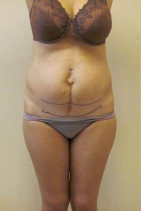 Tummy-Tuck-Case-3212 | Before Tummy Tuck