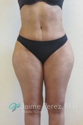 Tummy-Tuck-Case-5497 | After Tummy Tuck