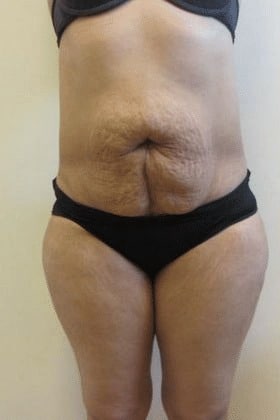 Tummy-Tuck-Case-5497 | Before Tummy Tuck