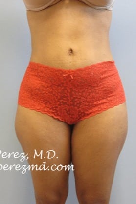 Tummy-Tuck-Case-2703 | After Tummy Tuck