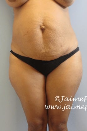 Tummy-Tuck-Case-2703 | Before Tummy Tuck