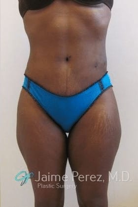 Tummy-Tuck-Case-9919 | After Tummy Tuck