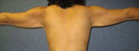 Arm-Lift-Case-3342 | Before Arm Lift