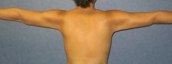 Arm-Lift-Case-3342 | After Arm Lift