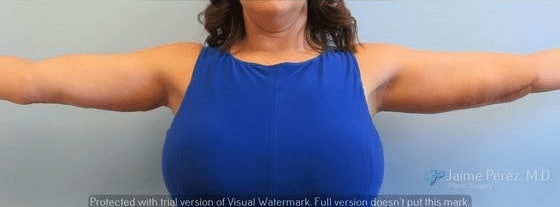 Arm-Lift-Case-3462 | After Arm Lift