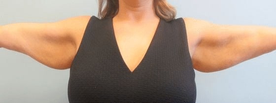 Arm-Lift-Case-3462 | Before Arm Lift