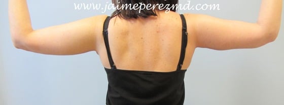 Arm-Lift-Case-9511 | After Arm Lift