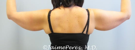 Arm-Lift-Case-9511 | Before Arm Lift