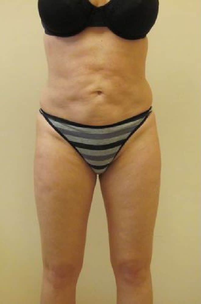 Botched-Surgery-Case-6978 | Before Botched Surgery