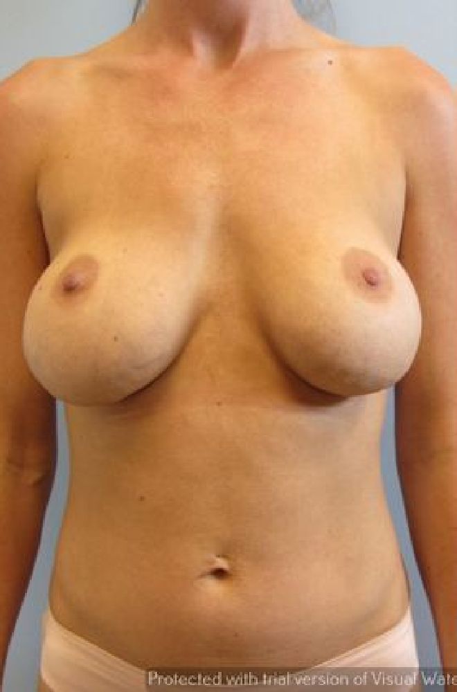 Breast-Revision-Case-4197 | Before Breast Revision