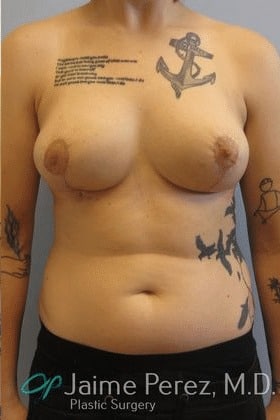 Breast-Reduction-Case-9262 | After Breast Reduction