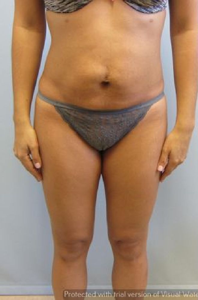 Tummy-Tuck-Case-3452 | Before Tummy Tuck