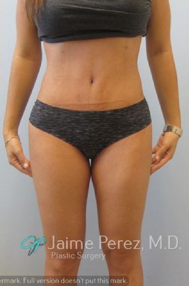 Tummy-Tuck-Case-3452 | After Tummy Tuck