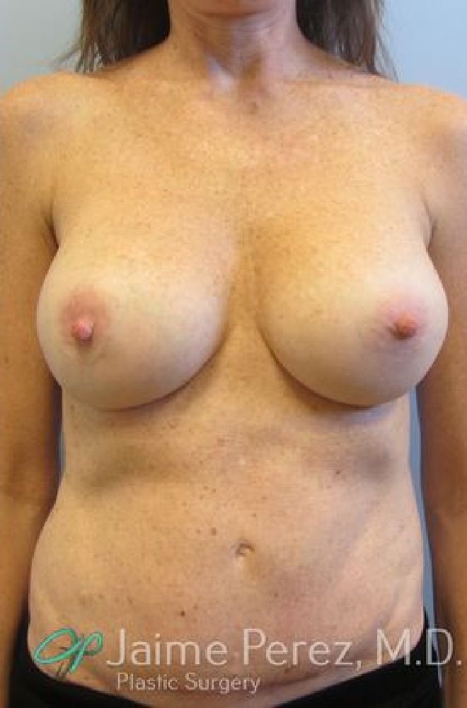 Breast-Revision-Case-1916 | After Breast Revision