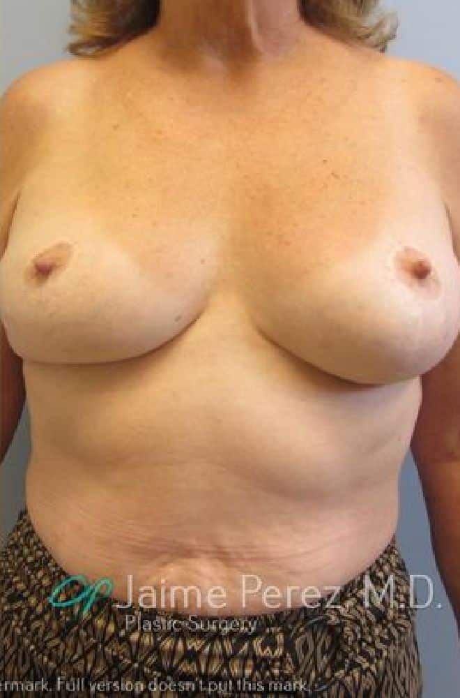 Breast-Reduction-Case-6172 | After Breast Reduction