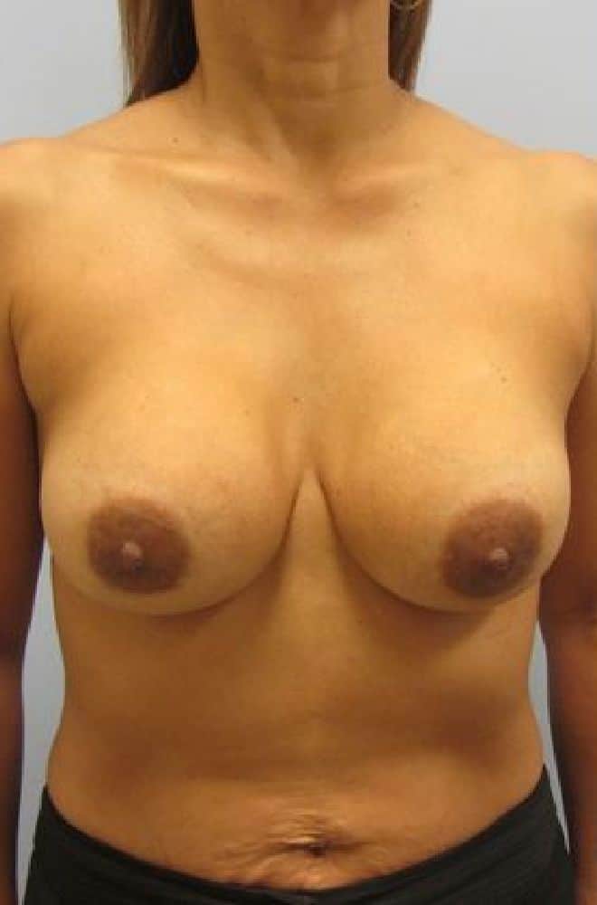 Breast-Revision-Case-5125 | Before Breast Revision