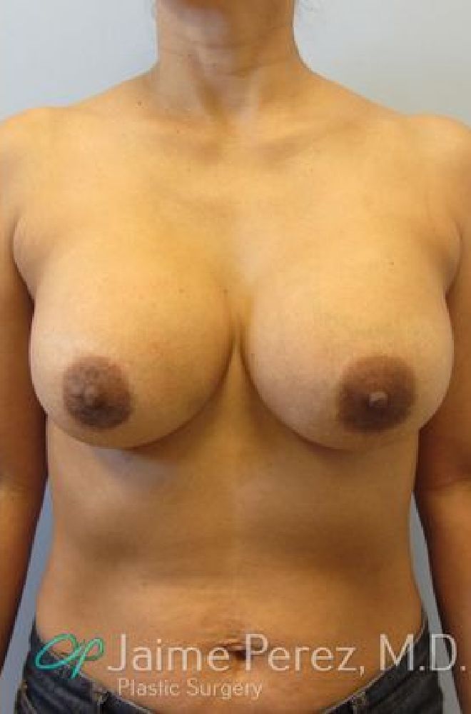 Breast-Revision-Case-5125 | After Breast Revision