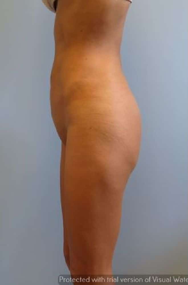 Buttock-Implants-Case-9137 | Before Buttock Implants