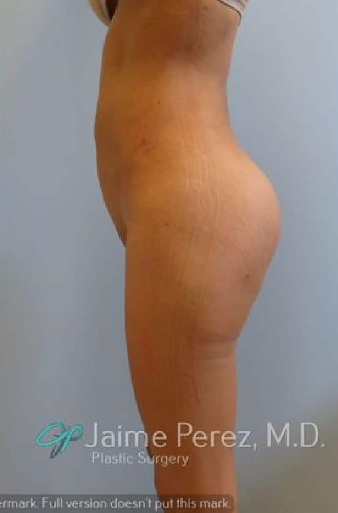Buttock-Implants-Case-9137 | After Buttock Implants