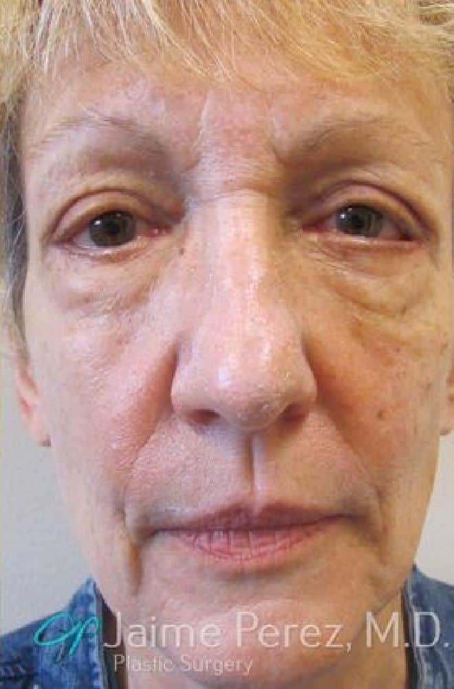 Fat-Grafting-Case-7481 | After Fat grafting