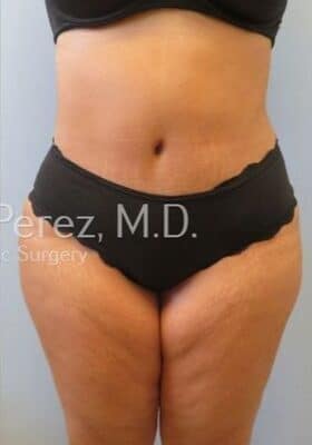 Tummy-Tuck-Case--4655 | After Tummy Tuck