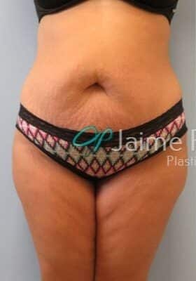 Tummy-Tuck-Case--4655 | Before Tummy Tuck