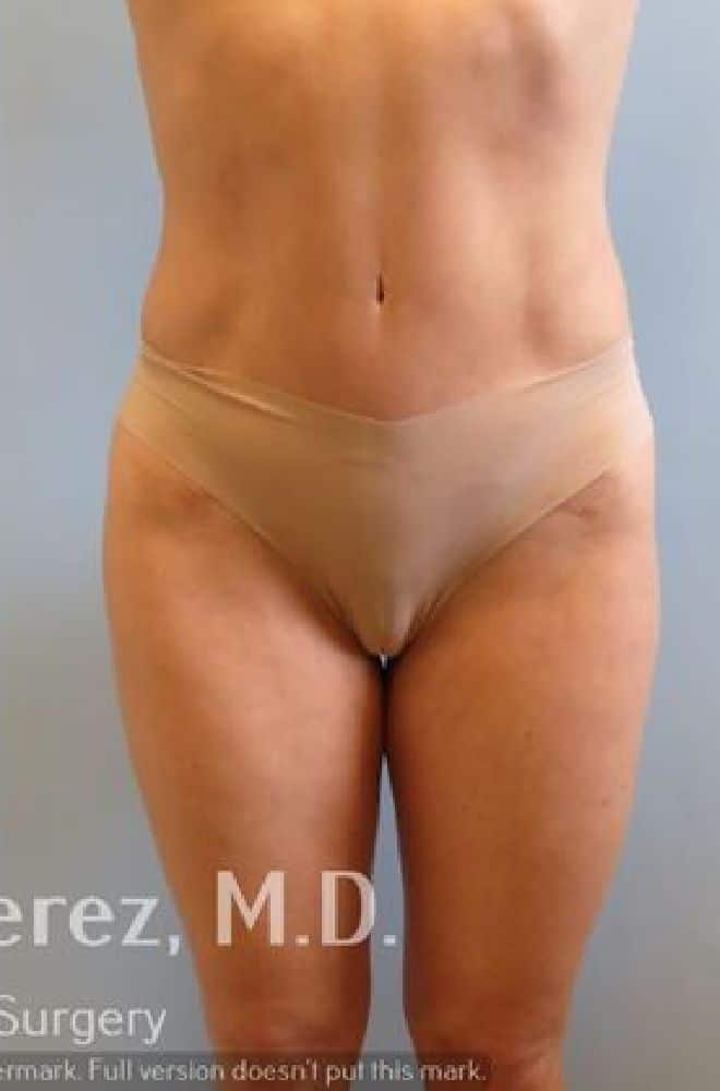 Fat-Transfer-Case-5751 | After Liposuction