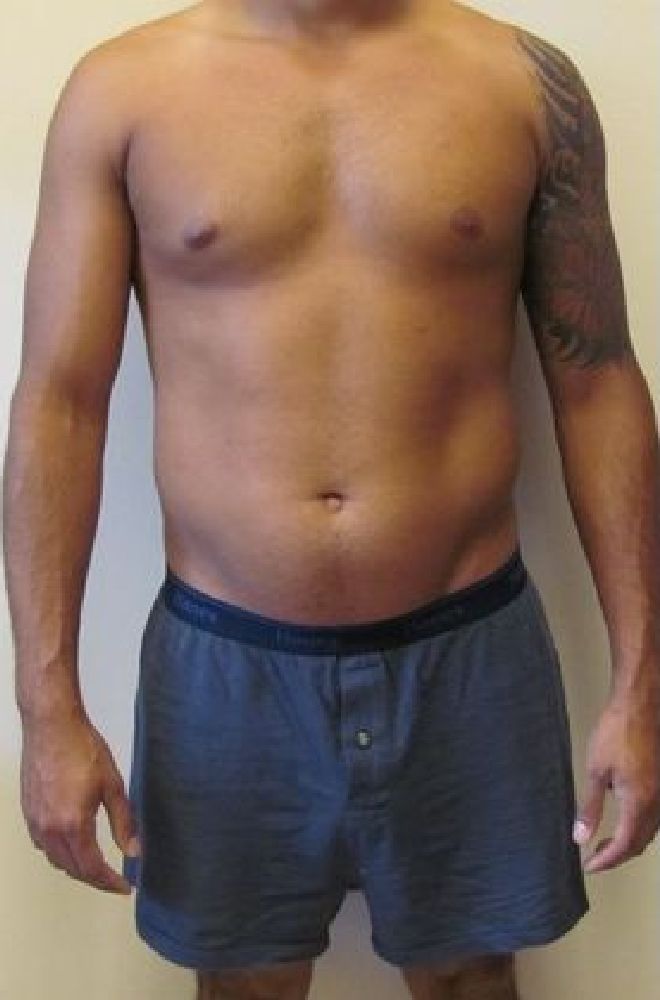 Lipo-Etching-Case-9748 | Before Lipo Etching