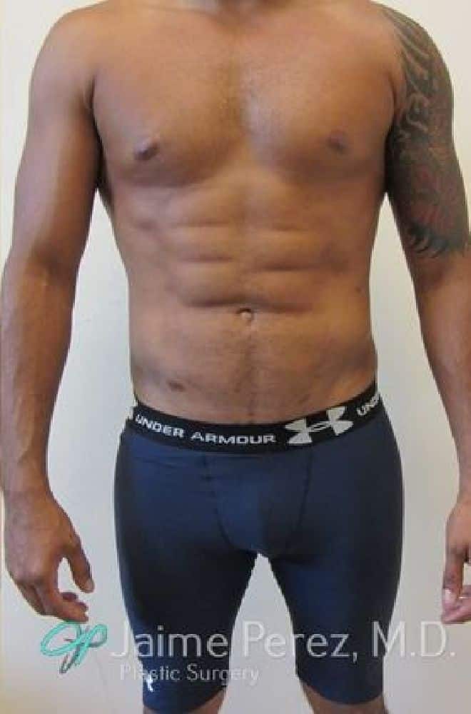 Lipo-Etching-Case-9748 | After Lipo Etching