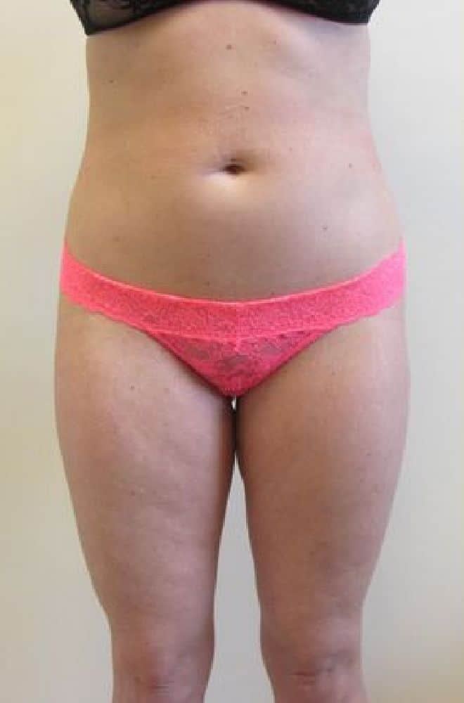 Lipo-Etching-Case-1471 | Before Lipo Etching