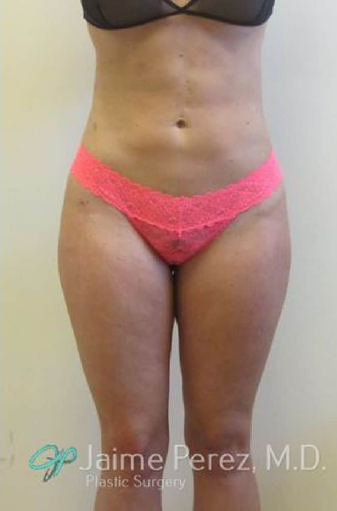 Lipo-Etching-Case-1471 | After Lipo Etching