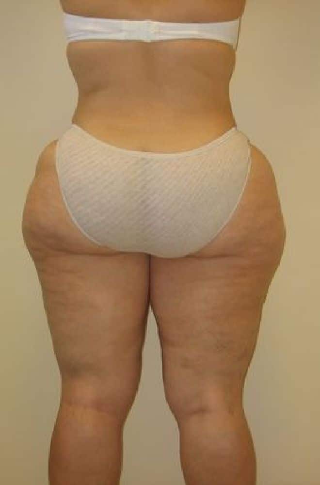 Liposuction-Case--1709 | Before Liposuction