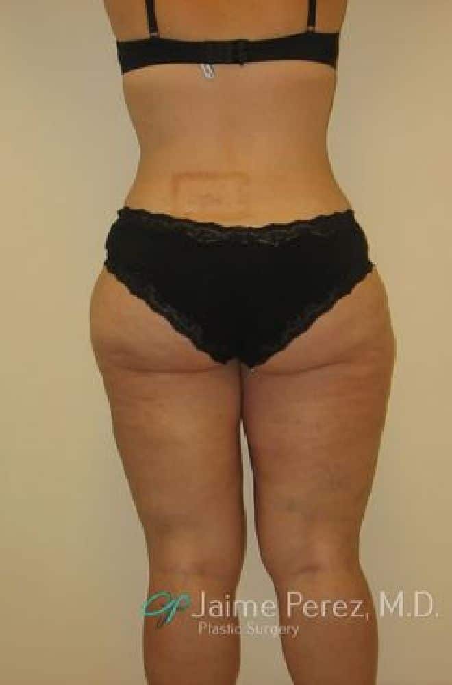 Liposuction-Case--1709 | After Liposuction