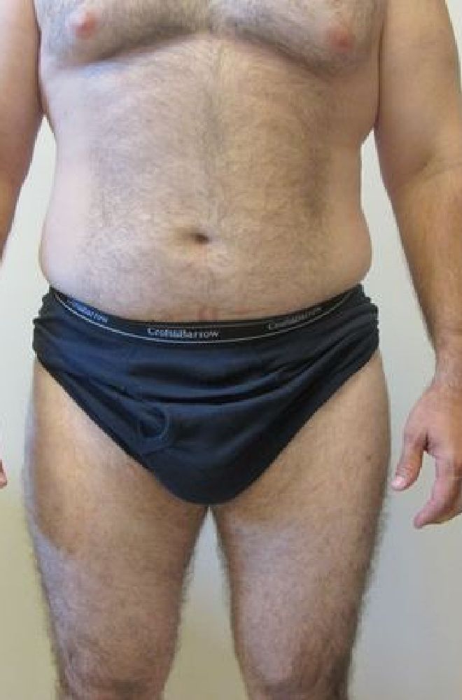 Male-Liposuction-Case-5313 | Before Liposuction