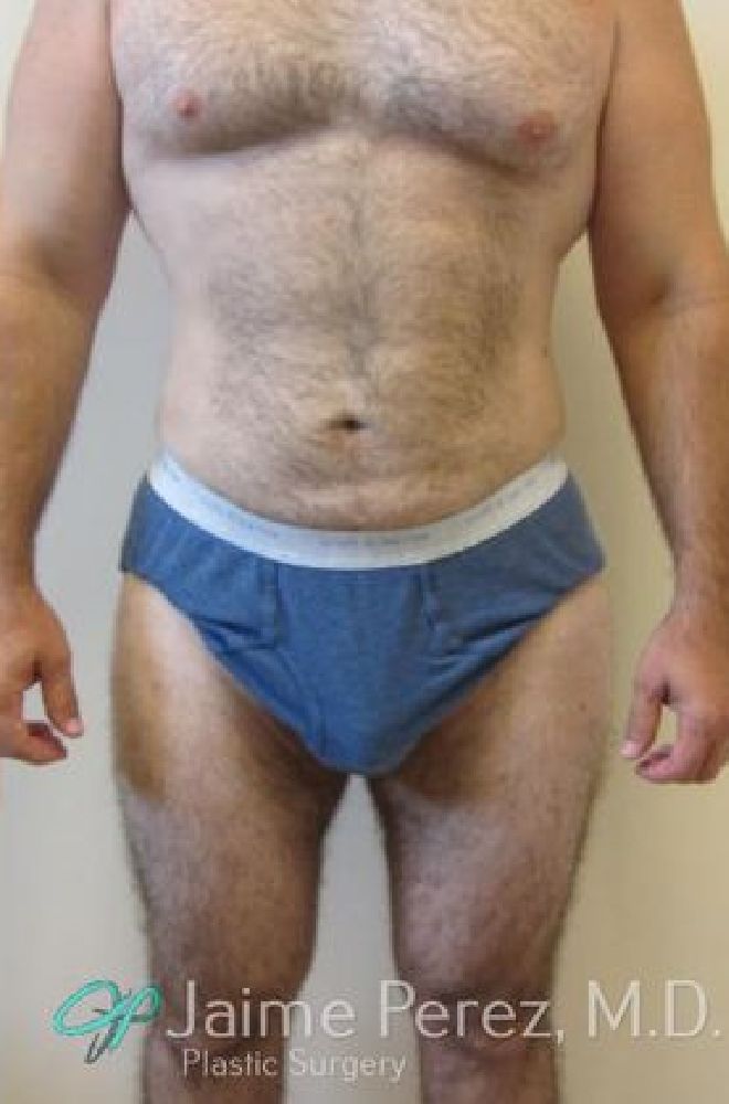 Male-Liposuction-Case-5313 | After Liposuction