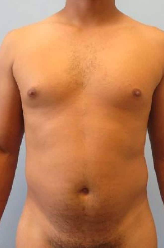 Abdominal-Etching-Case-4435 | Before Liposuction