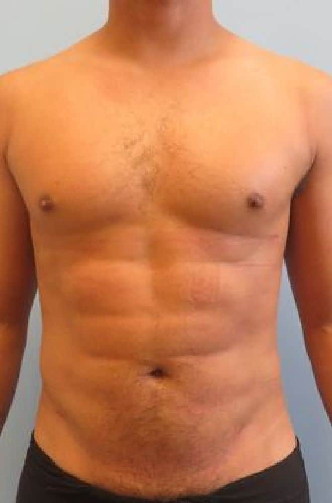 Abdominal-Etching-Case-4435 | After Liposuction