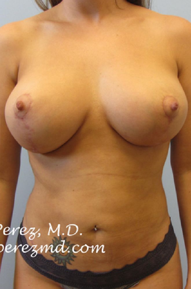 Breast-Lift-Case-2753 | After Liposuction
