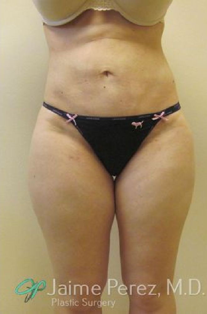 Tummy-Tuck-Case-2231 | After Tummy Tuck