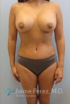 Mommy-Makeover-Case-7525 | After Mommy Makeover